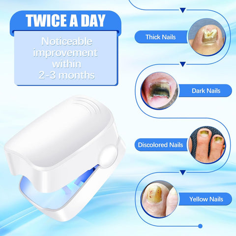 Rechargeable Nail Fungus Treatment for Toenail, Toe Nail Fungal Treatment Nail Fungus Laser Device, Anti-Fungal Nail Treatment for Hand & Feet Infections Remover for Home Use - jugaad.shop